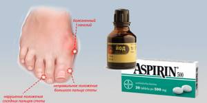 Йод и аспирин от косточек на ногах: компоненты лечебного средства и эффективность, показания и противопоказания к использованию, народные рецепты и инструкция