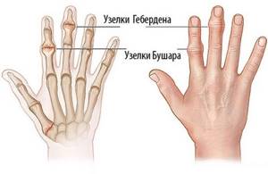 Артроз пальцев рук: причины развития заболевания и его первые признаки, медикаментозные и народные методы лечения, польза ЛФК и массажа, осложнения и профилактика патологии