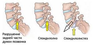Спондилолистез: классификация разновидностей, последствия и осложнения болезни, лечение шейного, грудного и поясничного отдела