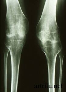 Виды артритов и их диагностика: клинический осмотр, лабораторное исследование, рентгенография и ультразвуковые методики определения заболевания