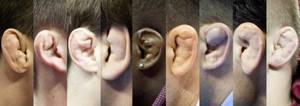 Перелом уха: классификация и причины повреждения ушной раковины, специфические симптомы и способы лечения, сроки восстановления, возможные осложнения и прогноз