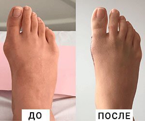 Применение медицинской желчи при косточках на ногах: целебные свойства, инструкция по использованию и противопоказания, правила лечения