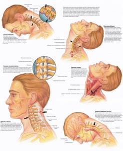 Болит шея сзади у основания черепа: симптомы и клиническая картина, массаж и лечебная физкультура, способы терапии и нежелательные действия при болях