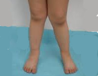 Х - образные ноги у ребенка: что это такое, симптомы деформации, гимнастика и массаж в борьбе с болезнью, консервативные методы терапии