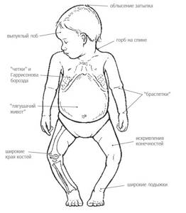 Варусная деформация нижних конечностей у детей: причины и симптомы развития патологии, диагностика, консервативное, хирургическое и физиотерапевтическое лечение