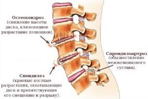 Жжение в спине при остеохондрозе: терапия с использованием медикаментов, признаки и особенности недуга, физиотерапевтические методы и возможные болезни
