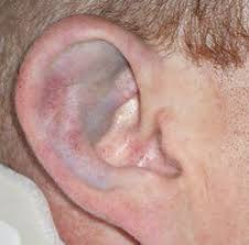 Перелом уха: классификация и причины повреждения ушной раковины, специфические симптомы и способы лечения, сроки восстановления, возможные осложнения и прогноз