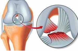 Порванные связки на ноге: симптомы и признаки, диагностика и лечебные методы, классификация травм
