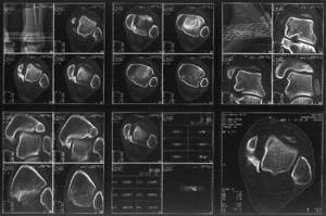 МРТ голеностопного сустава: информативность методики, показания и противопоказания к назначению, подготовка и техника проведения исследования, стоимость диагностики
