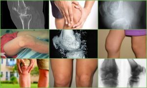 Хондроматоз суставов: что это такое, причины и признаки заболевания, методы лечения и проявления на ногах