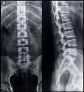Показывает ли рентген грыжу позвоночника: подготовка к процедуре и методы диагностики, показания и противопоказания к обследованию, расшифровка снимков