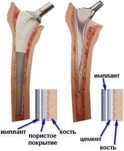 Эндопротез тазобедренного сустава: виды имплантов и способы фиксации, схема расположения и стоимость протеза, обзор лучших