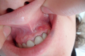 Остеомиелит челюсти (нижней или верхней): причины, симптомы, хроническая стадия и лечение