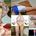 Какие компрессы при артрозе коленного сустава нужно делать: виды, преимущества использования народных методик, рецепты, отзывы пациентов