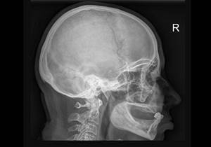 Перелом основания черепа: классификация травм, отличительные признаки и симптомы, методы диагностики, первая помощь и способы лечения, последствия и прогноз для жизни