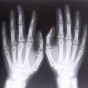 Рентген кисти руки: в каких случаях назначается, противопоказания, проведение процедуры, расшифровка результатов и альтернативные диагностические методы