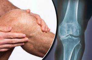 Острый артроз коленного сустава: симптомы и причины заболевания, лечение и профилактика обострения, методы диагностики