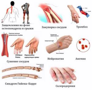 Почему немеют кисти рук: основные причины нарушений, возможные заболевания, методы диагностики, что делать, лечение и профилактика