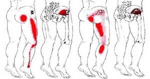 Боль в тазобедренном суставе, отдающая в ногу и ягодицу: факторы, провоцирующие неприятные ощущения, диагностические мероприятия, лечение и профилактика