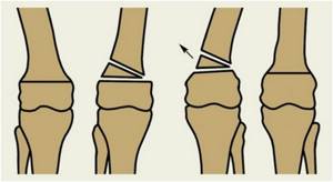 Вальгусная деформация коленных суставов с фото: причины и симптомы, диагностика и 4 методики лечения, возможные осложнения
