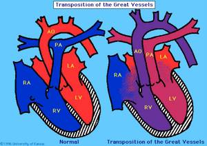 Декстрокардия - расположение сердце справа: причины, как протекает, признаки на ЭКГ, прогноз