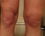 Болезнь Гоффа коленного сустава — лечение, симптомы, причины заболевания