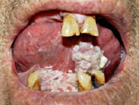 Рак полости рта: слизистой оболочки, щеки, неба, десны - симптомы онкологии ротовой полости, как выглядит