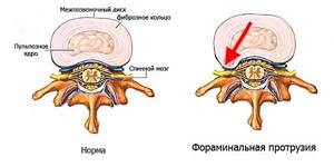 Что такое фораминальная грыжа межпозвонкового диска: симптомы, диагностика и лечение