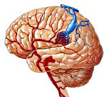 Мальформация сосудов головного мозга (артериовенозная, синдром Арнольда Киари, Денди Уокера и другие): причины, симптомы и лечение
