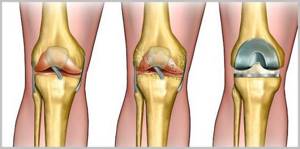 Деформирующий артрит суставов: симптомы и лечение