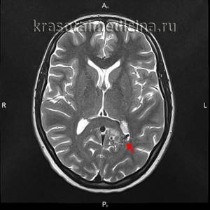Мальформация сосудов головного мозга (артериовенозная, синдром Арнольда Киари, Денди Уокера и другие): причины, симптомы и лечение