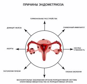 Месячные при эндометриозе: как проходят, может ли быть задержка