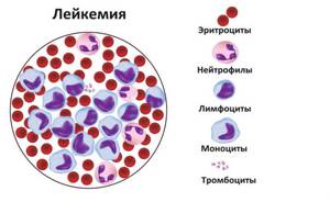 Анемия 1 степени: что это такое, легкой, тяжелой, по гемоглобину