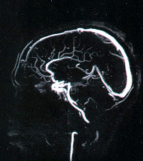 Дистония сосудов головного мозга: симптомы, как укрепить сосуды при ВСД, как лечить