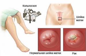 Лечение рака шейки матки