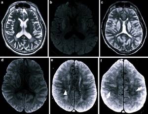 Диффузные изменения биоэлектрической активности головного мозга: легкие, умеренные, выраженные