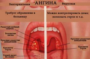 Хлоргексидин при ангине для полоскания горла взрослому: как полоскать и можно ли при тонзиллите гнойном, лечение и как разводить, применение