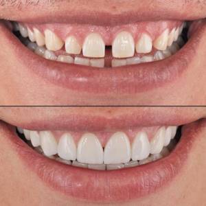 Виниры на зубы (зубные накладки): что это, как делают винирование зубов, виды, срок службы, фото до и после