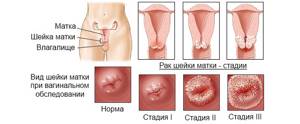 Симптомы рака шейки матки на ранней стадии
