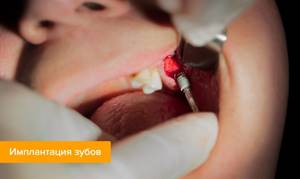Имплантация зубов: противопоказания для установки зубных имплантов, возможные осложнения