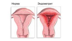 Хронический эндометрит матки