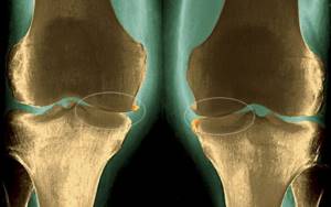 Деформирующий остеоартроз голеностопного сустава: 1-2 степени
