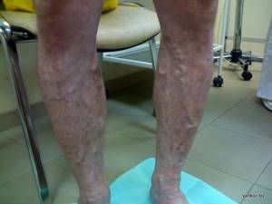 Склеротерапия вен ног: эффективный метод для незапущенного варикоза