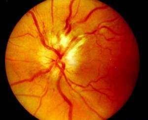 Ретробульбарный неврит зрительного нерва: симптомы, лечение, причины