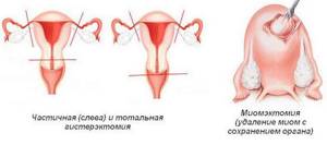 Гомеопатия при миоме матки