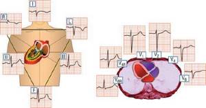 Декстрокардия - расположение сердце справа: причины, как протекает, признаки на ЭКГ, прогноз