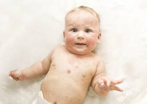 Потница у детей (7 фото): лечение, симптомы раздражения кожи