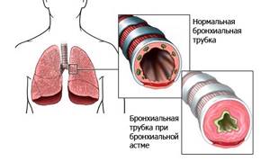 Бронхиальная астма у детей: признаки и симптомы, классификация, динамика заболеваемости, лечение, базисная терапия, последние разработки, диета, профилактика