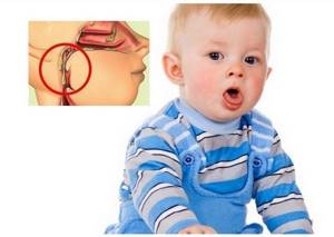 Сухой ринит: симптомы и лечение насморка в носу у ребенка - как лечить передний