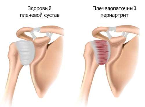 Синовит плечевого сустава: симптомы и лечение